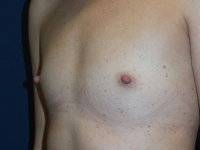 Breast Augmentation by Dr. Haydon Before & After Gallery - Patient 55709036 - Image 1