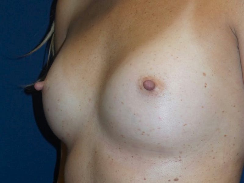 Breast Augmentation by Dr. Haydon Before & After Gallery - Patient 55709036 - Image 2