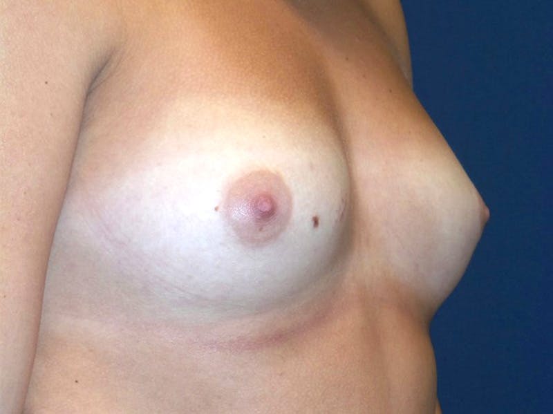 Breast Augmentation by Dr. Haydon Before & After Gallery - Patient 55709035 - Image 1