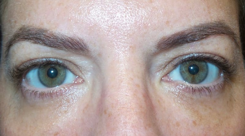 Eyelid Surgery by Dr. Haydon Before & After Gallery - Patient 55709038 - Image 1