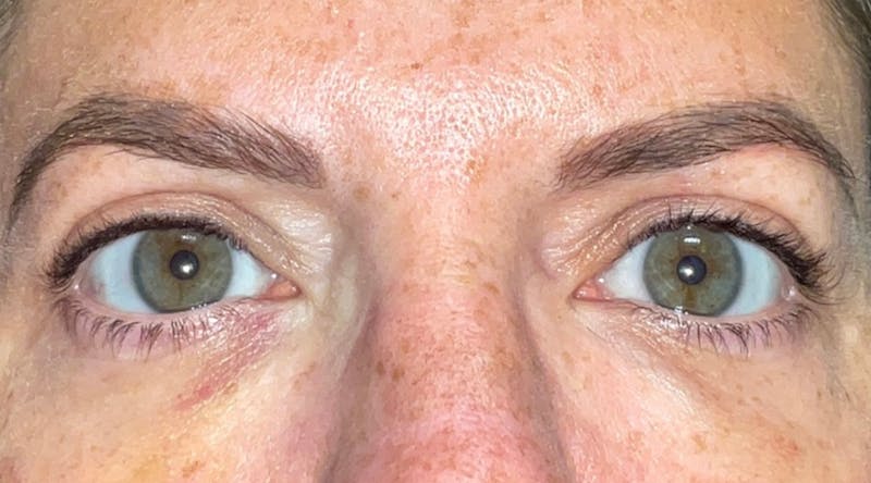 Eyelid Surgery by Dr. Haydon Before & After Gallery - Patient 55709038 - Image 2