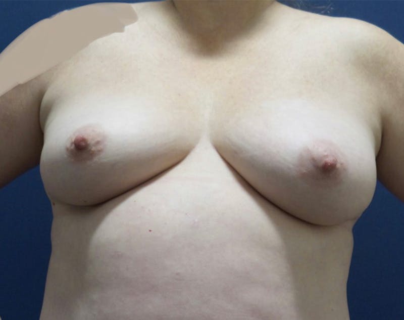 Breast Lift by Dr. Haydon Before & After Gallery - Patient 55709046 - Image 1