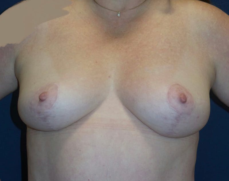 Breast Lift by Dr. Haydon Before & After Gallery - Patient 55709046 - Image 2