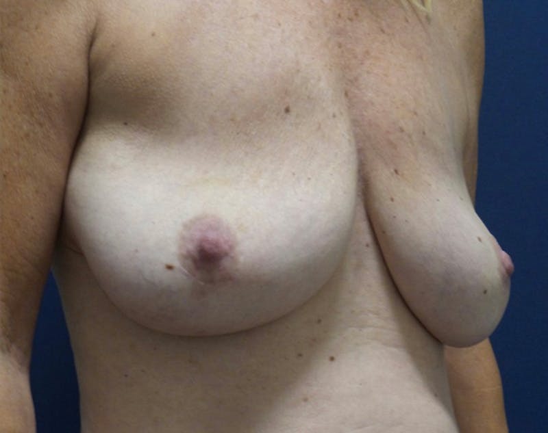 Breast Lift by Dr. Haydon Before & After Gallery - Patient 55709045 - Image 1