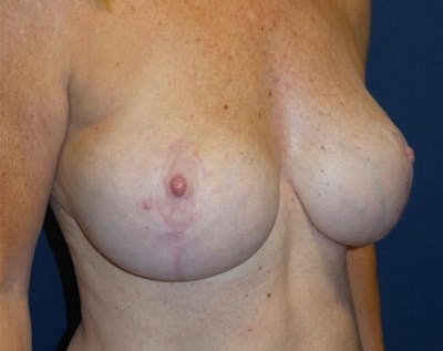 Breast Lift by Dr. Haydon Before & After Gallery - Patient 55709045 - Image 2
