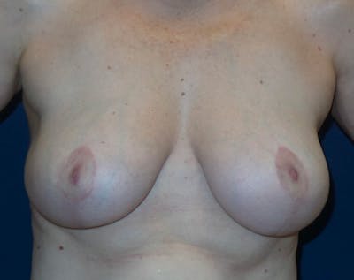 Breast Lift by Dr. Haydon Before & After Gallery - Patient 55709053 - Image 2