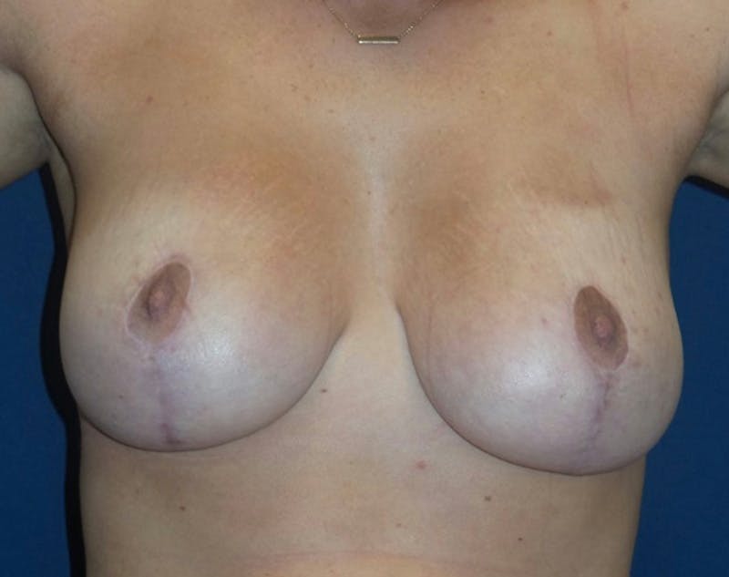 Breast Lift by Dr. Haydon Before & After Gallery - Patient 55709048 - Image 2
