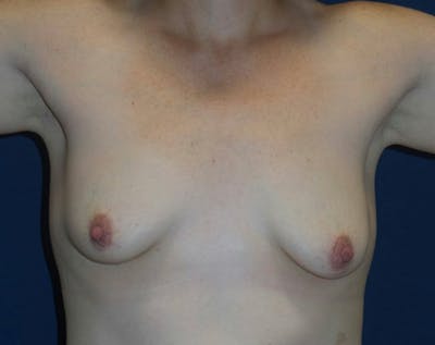 Breast Lift by Dr. Haydon Before & After Gallery - Patient 55709051 - Image 1