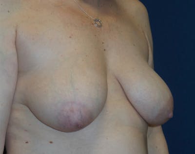 Breast Lift by Dr. Haydon Before & After Gallery - Patient 55709050 - Image 1