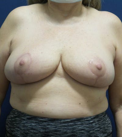 Breast Reduction by Dr. Haydon Before & After Gallery - Patient 55709058 - Image 2