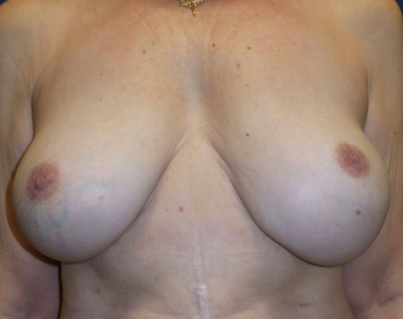 Breast Revision by Dr. Haydon Before & After Gallery - Patient 55709060 - Image 2