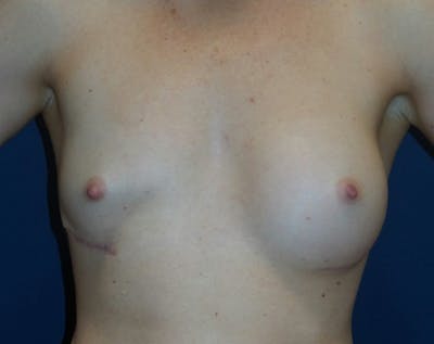 Breast Revision by Dr. Haydon Before & After Gallery - Patient 55709061 - Image 1