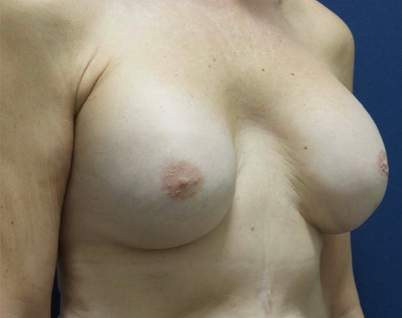 Breast Revision by Dr. Haydon Before & After Gallery - Patient 55709060 - Image 3