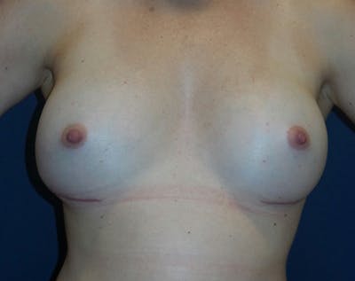 Breast Revision by Dr. Haydon Before & After Gallery - Patient 55709061 - Image 2
