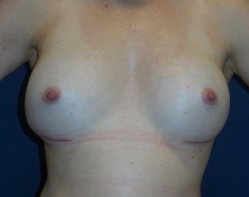 Breast Revision by Dr. Haydon Before & After Gallery - Patient 55709061 - Image 2