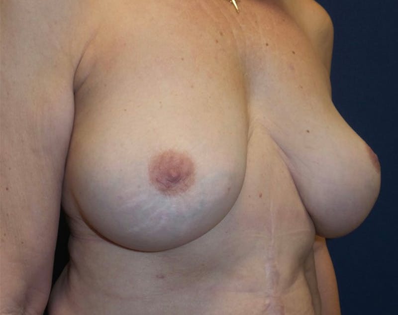 Breast Revision by Dr. Haydon Before & After Gallery - Patient 55709060 - Image 4