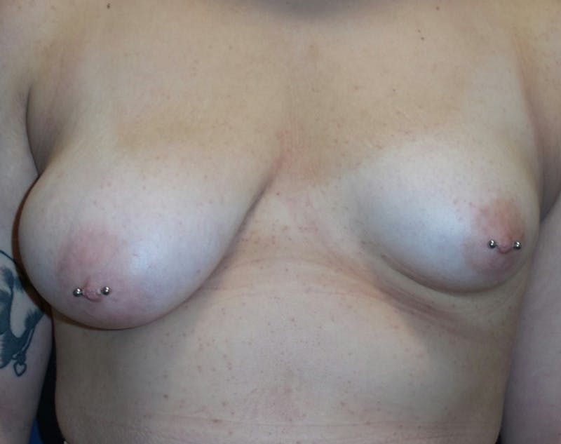 Breast Revision by Dr. Haydon Before & After Gallery - Patient 55709062 - Image 1