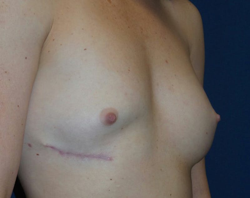 Breast Revision by Dr. Haydon Before & After Gallery - Patient 55709061 - Image 3