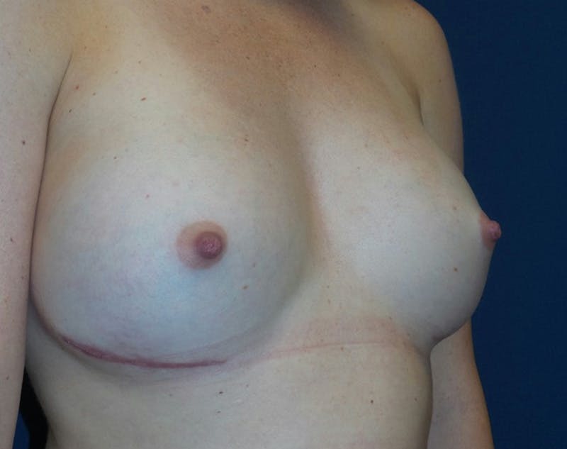 Breast Revision by Dr. Haydon Before & After Gallery - Patient 55709061 - Image 4