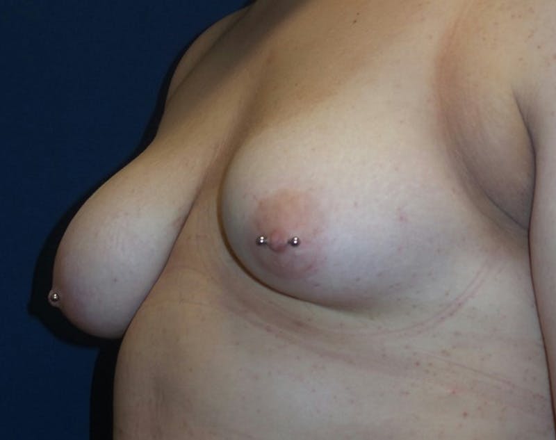 Breast Revision by Dr. Haydon Before & After Gallery - Patient 55709062 - Image 3