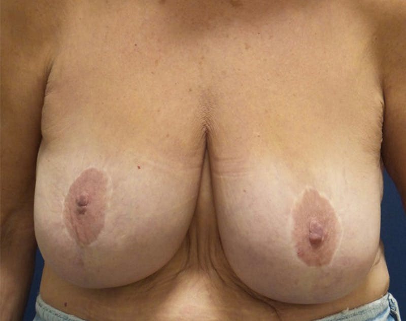 Breast Revision by Dr. Haydon Before & After Gallery - Patient 55709064 - Image 1