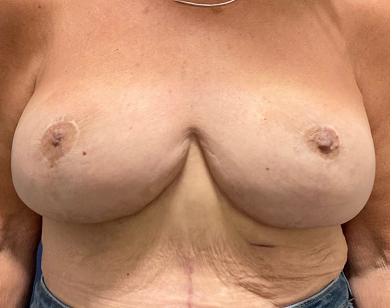 Breast Revision by Dr. Haydon Before & After Gallery - Patient 55709064 - Image 2