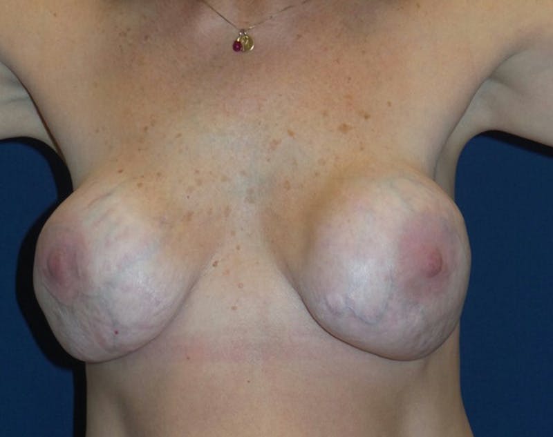 Breast Revision by Dr. Haydon Before & After Gallery - Patient 55709065 - Image 1