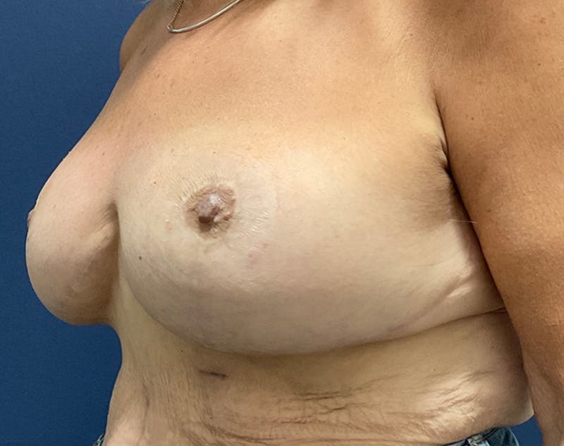 Breast Revision by Dr. Haydon Before & After Gallery - Patient 55709064 - Image 4