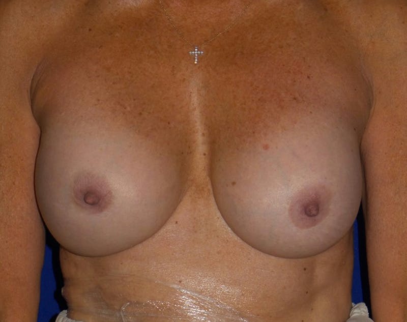 Breast Revision by Dr. Haydon Before & After Gallery - Patient 55709063 - Image 2
