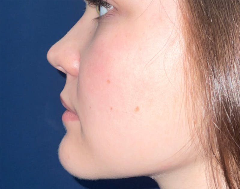 Buccal Fat Pad Removal by Dr. Haydon Before & After Gallery - Patient 60419318 - Image 1