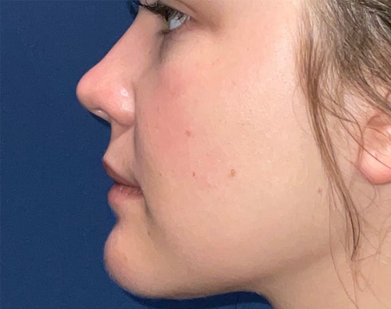 Buccal Fat Pad Removal by Dr. Haydon Before & After Gallery - Patient 60419318 - Image 2