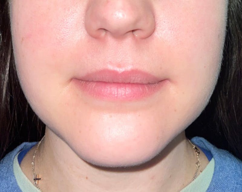Buccal Fat Pad Removal by Dr. Haydon Before & After Gallery - Patient 60419318 - Image 3