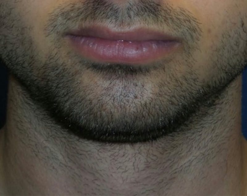 Chin Augmentation by Dr. Haydon Before & After Gallery - Patient 55709067 - Image 1