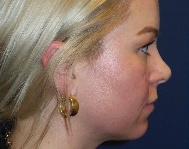 Chin Augmentation by Dr. Haydon Before & After Gallery - Patient 55709068 - Image 1