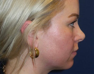 Chin Augmentation by Dr. Haydon Gallery - Patient 55709068 - Image 1