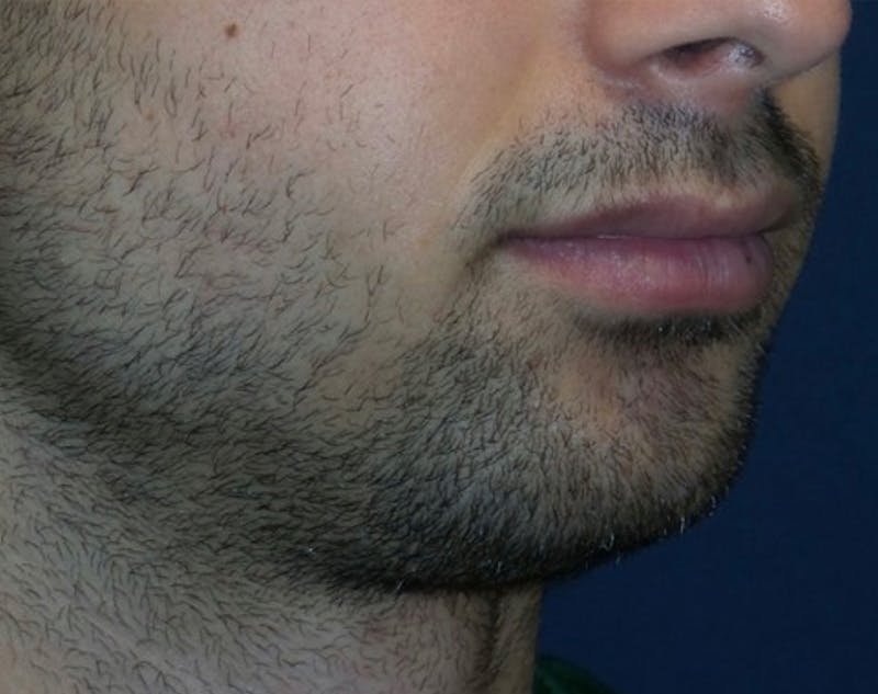 Chin Augmentation by Dr. Haydon Before & After Gallery - Patient 55709067 - Image 3