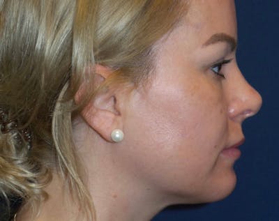Chin Augmentation by Dr. Haydon Gallery - Patient 55709068 - Image 2