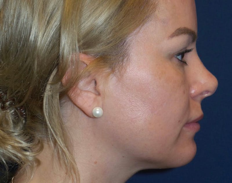 Chin Augmentation by Dr. Haydon Before & After Gallery - Patient 55709068 - Image 2