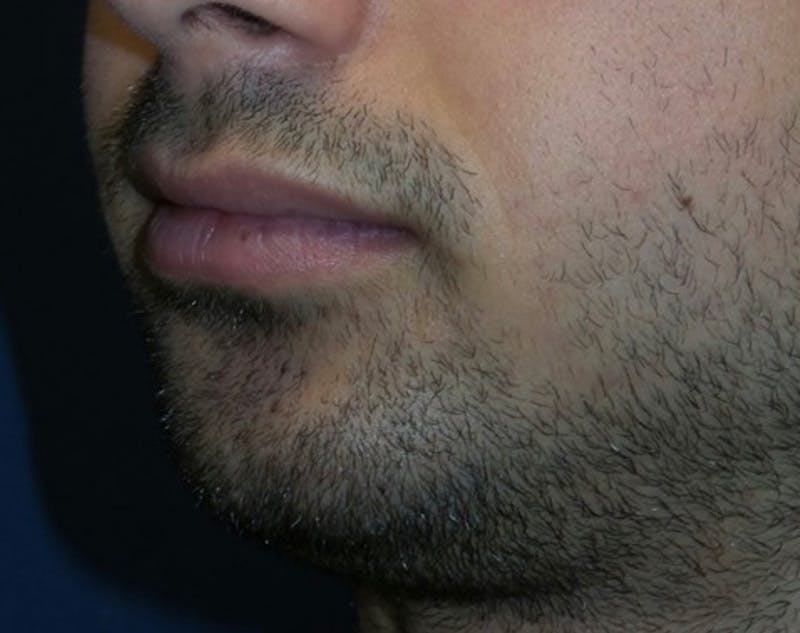 Chin Augmentation by Dr. Haydon Before & After Gallery - Patient 55709067 - Image 5