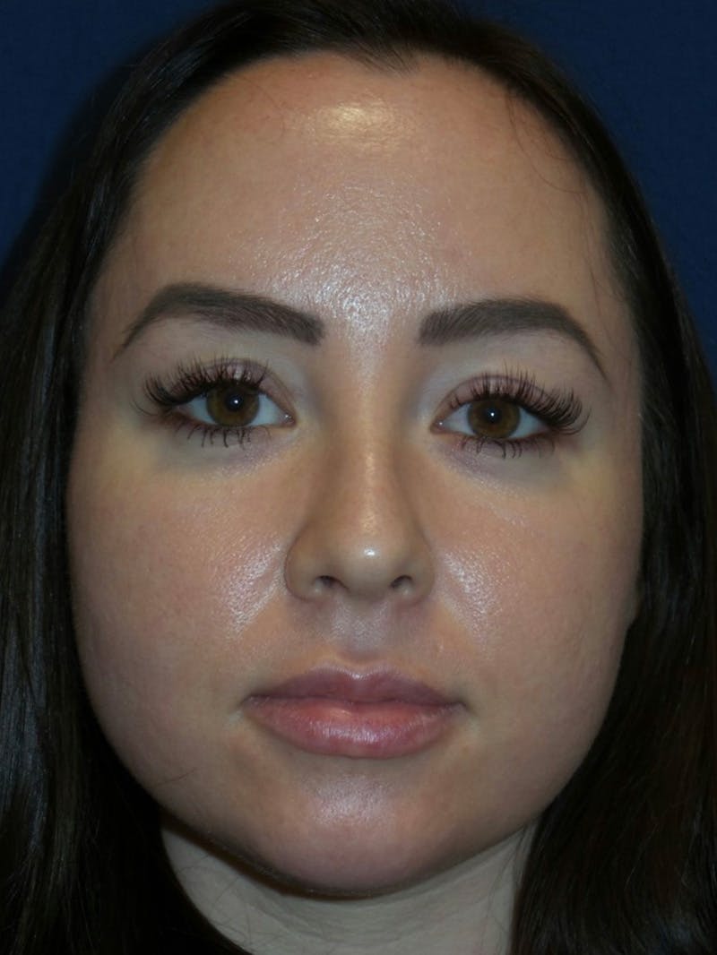 Inmode by Dr. Haydon Before & After Gallery - Patient 55709071 - Image 1