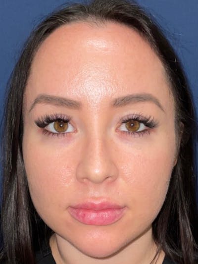 Inmode by Dr. Haydon Before & After Gallery - Patient 55709071 - Image 2