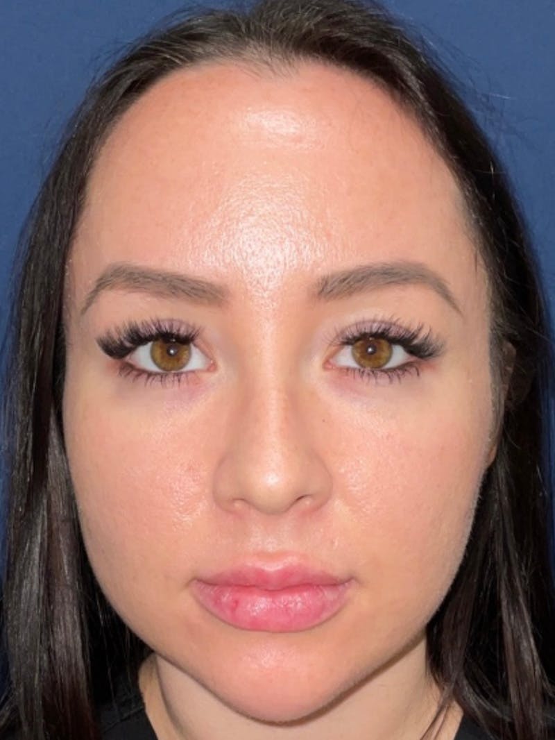 Inmode by Dr. Haydon Before & After Gallery - Patient 55709071 - Image 2