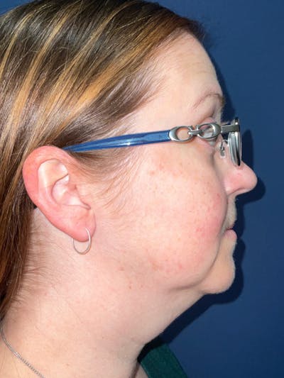 Inmode by Dr. Haydon Before & After Gallery - Patient 55709072 - Image 1