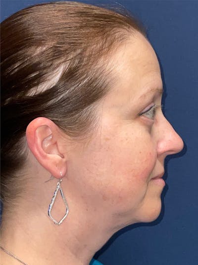 Inmode by Dr. Haydon Before & After Gallery - Patient 55709072 - Image 2