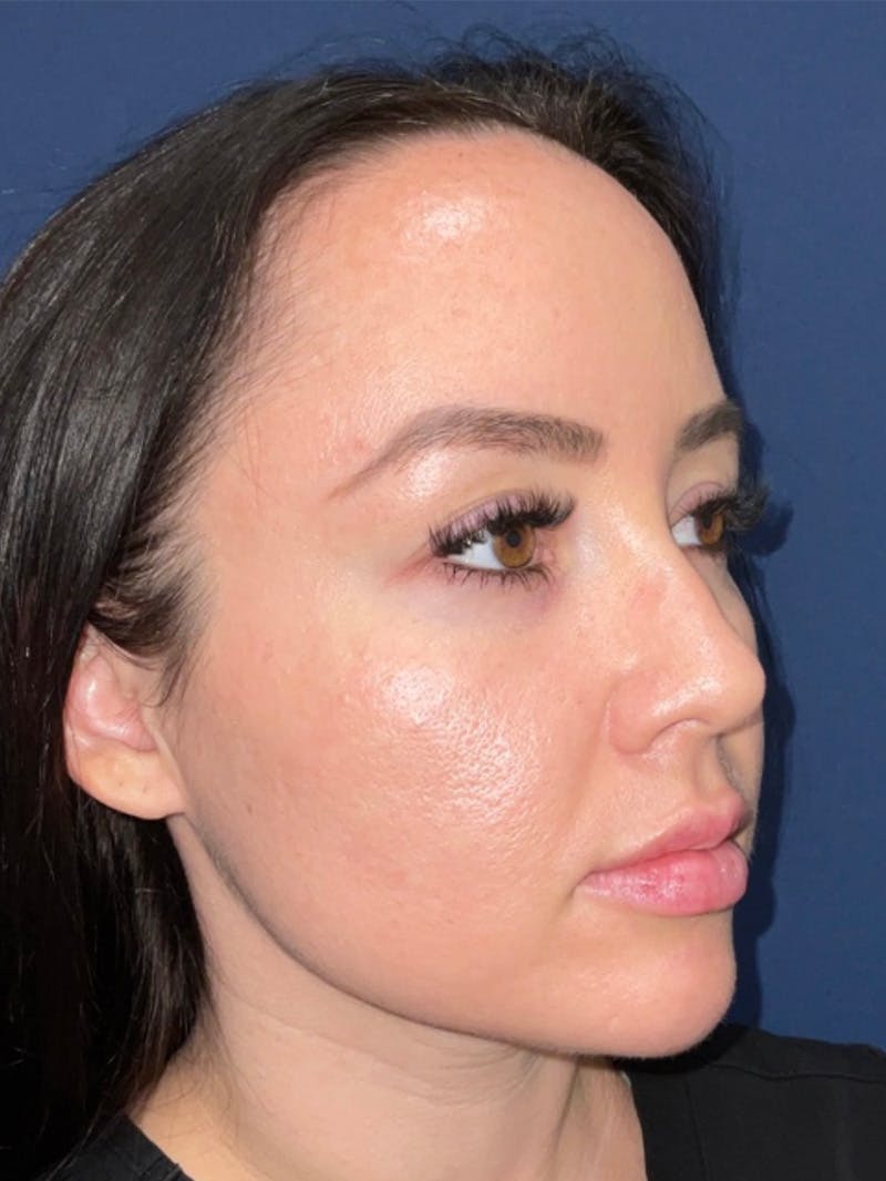 Inmode by Dr. Haydon Before & After Gallery - Patient 55709071 - Image 4