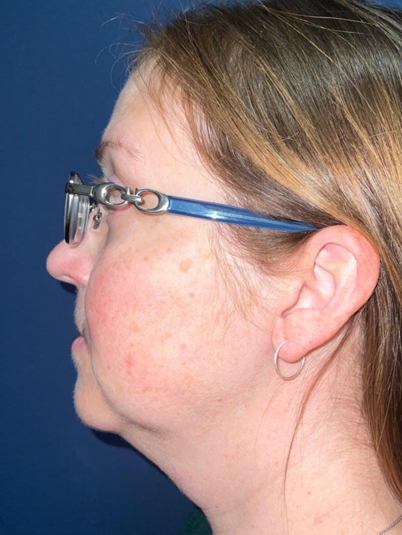 Inmode by Dr. Haydon Before & After Gallery - Patient 55709072 - Image 3