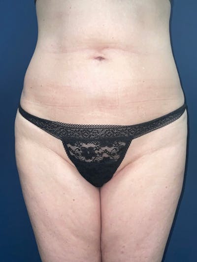 Inmode by Dr. Haydon Before & After Gallery - Patient 55709073 - Image 1