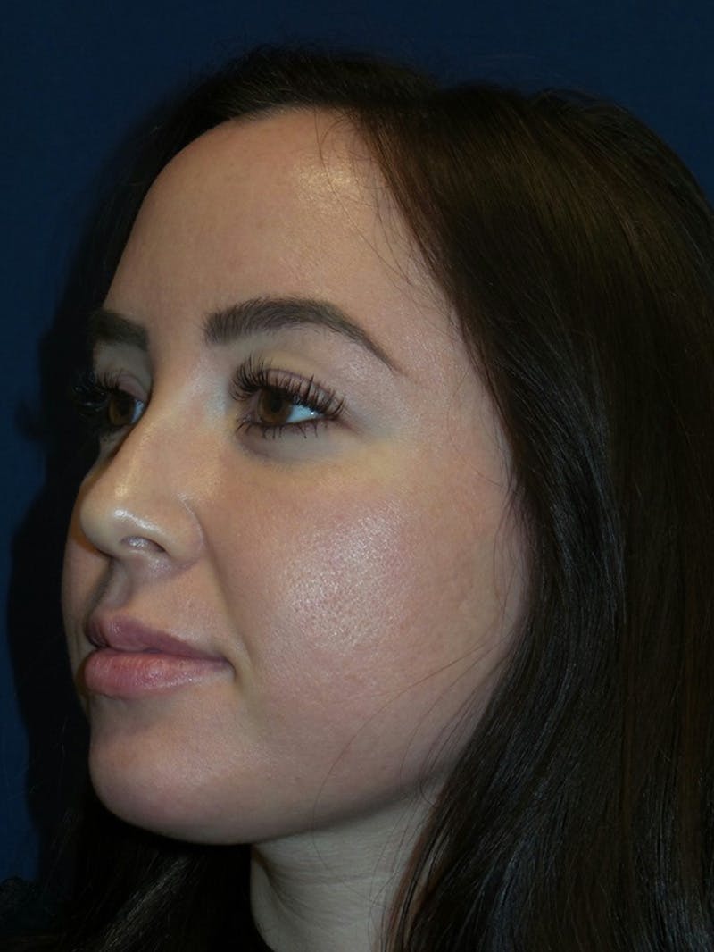 Inmode by Dr. Haydon Before & After Gallery - Patient 55709071 - Image 5