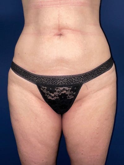 Inmode by Dr. Haydon Before & After Gallery - Patient 55709073 - Image 2