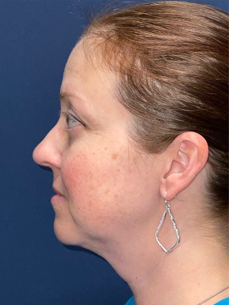 Inmode by Dr. Haydon Before & After Gallery - Patient 55709072 - Image 4